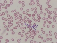 Sideroblastik Anemi Nedenleri?