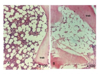 Fanconi Aplastik Anemisi Belirtileri ve Tedavisi